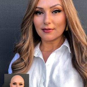 پروتز مو مردانه با طراحی بسیار طبیعی