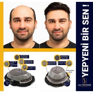 پروتز مو طبیعی برای افزایش تراکم مو