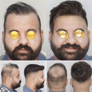 پروتز مو طبیعی هشت تکه مردانه | کد: ZNB-VTD