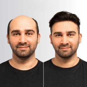 پروتز مو دور سیلیکون فاین مونو | مردانه درجه b | کد: ZNB-VAA