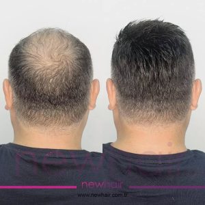 پروتز مو آنکارایی VIP | کد: ZNB-WH6