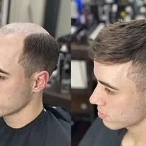 پروتز کف سر مردانه طبیعی انکارایی (کد:1038) – طبیعی | کد: ZNB-XOX