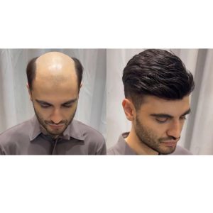 پروتز مردانه درمان ریزش موی مردانه skinny injection رنگ طبیعی مشکی سایز 9*7( 18cmعرض طول23cm) | کد: ZNB-VBY