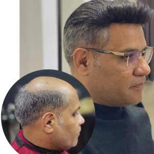 پروتز کف سر مردانه طبیعی لس آنجلسی(کد:1028) – طبیعی | کد: ZNB-WMK