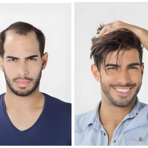 پروتز مو بالا سر مردانه لس آنجلسی دور پوست موی طبیعی کد 1102 | کد: ZNB-W0T